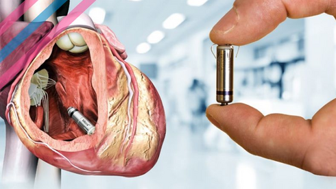 Featured image for "Israeli Breakthrough: Miniature Pacemaker Transplants in Patients"