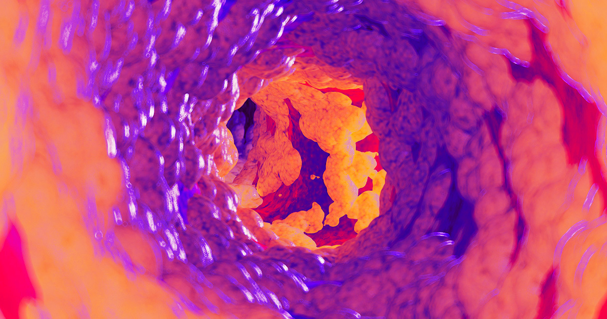 Featured image for "Excessive Protein Intake Linked to Arterial Damage and Cardiovascular Risk, Study Shows"