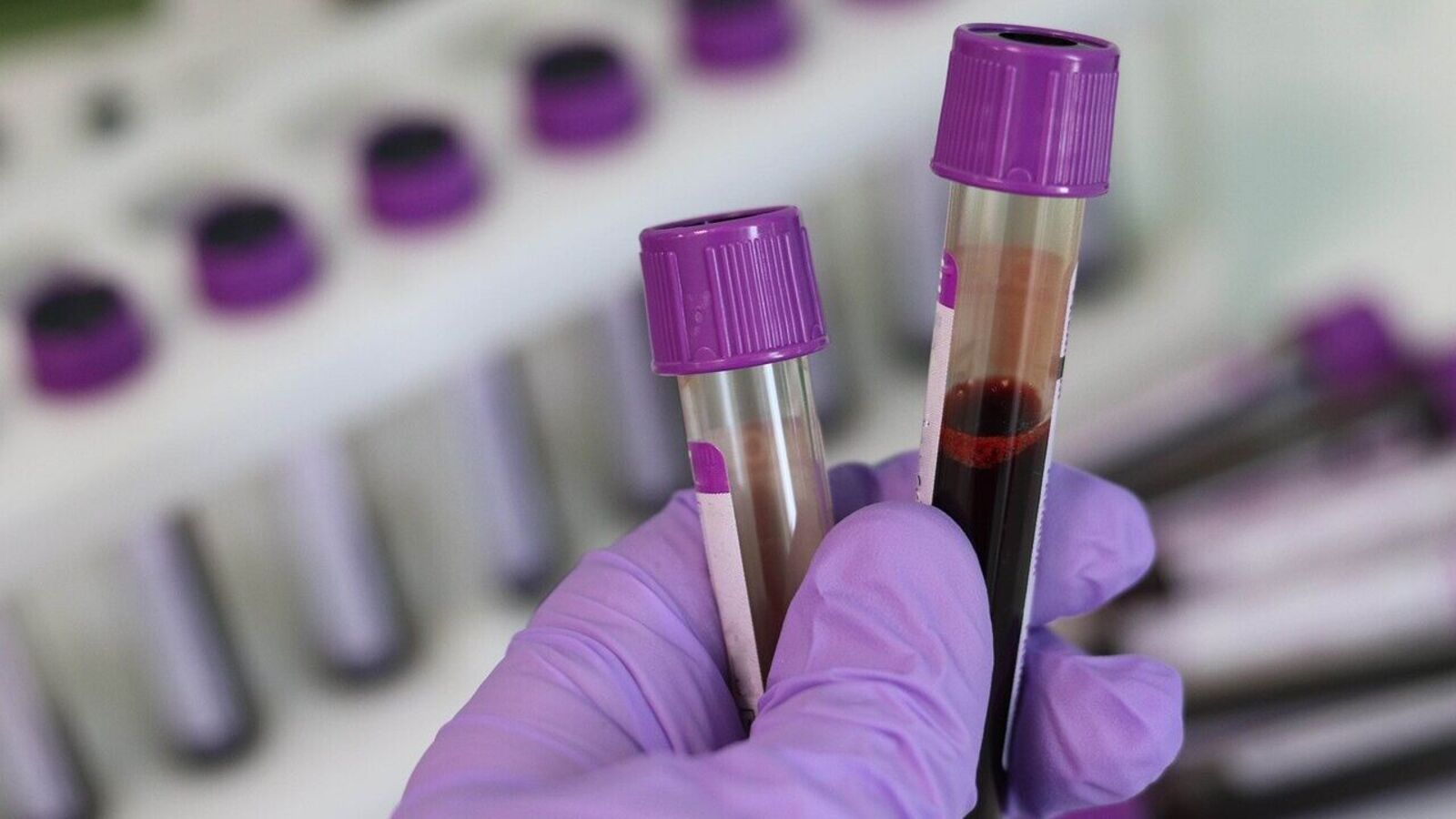 Featured image for Breakthrough Blood Test Detects Cancer with 99% Accuracy