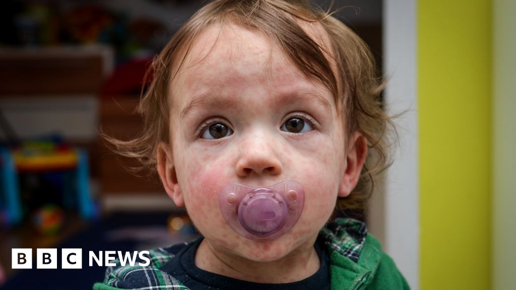 Measles Outbreak Looms in London: Urgent Warning to Parents