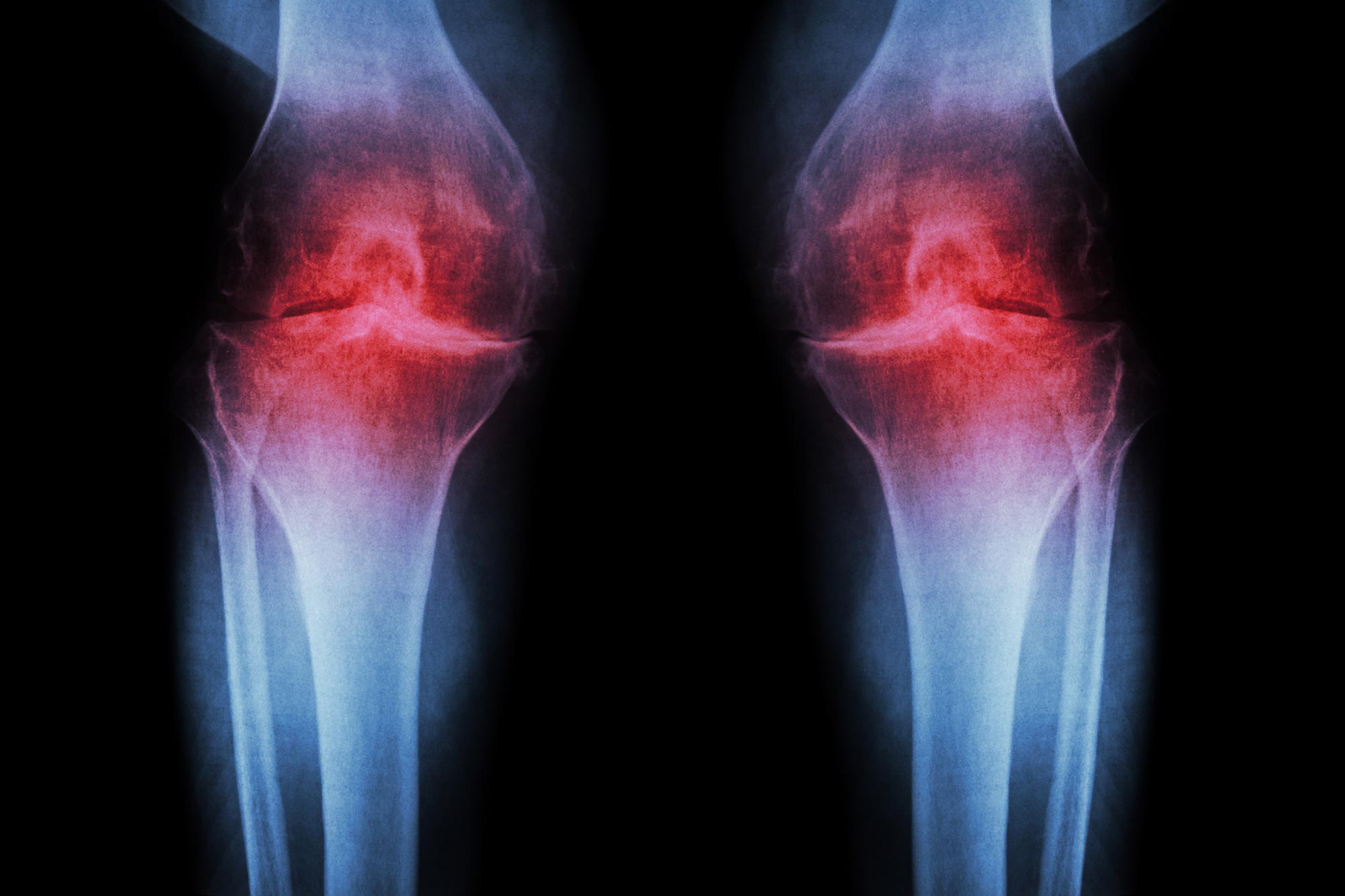 Featured image for Anti-Aging Injection Rejuvenates Knee Cartilage and Prevents Arthritis