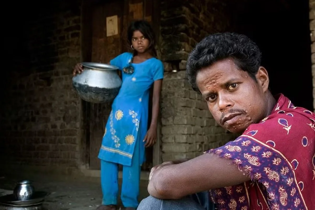 WHO calls to end stigma and integrate mental health in the NTD elimination fight