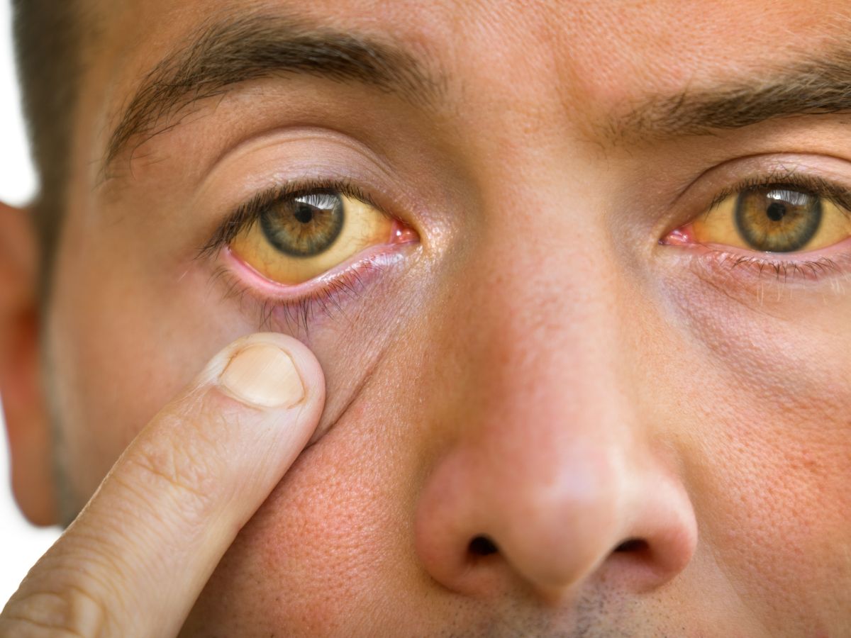 Featured image for "7 Eye Signs That Indicate High Cholesterol Levels"