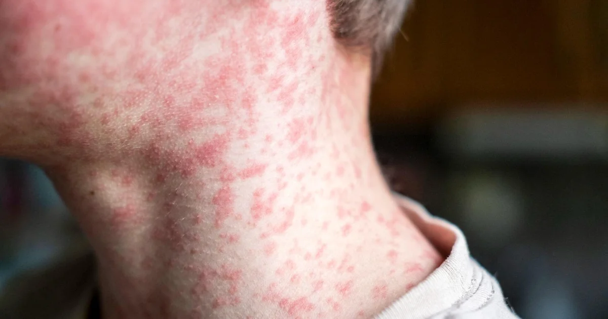 Over 150 South Carolina Students Quarantined Amid Measles Outbreak