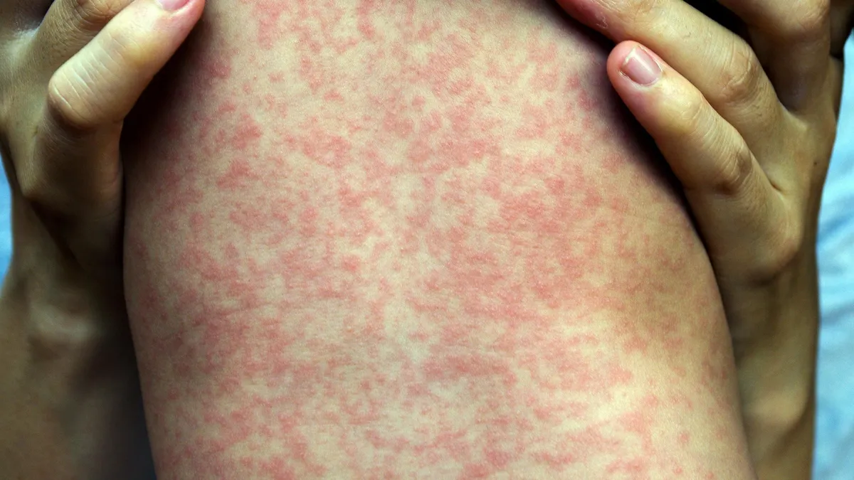 "Rising Concerns: Measles Outbreak Spreads in Philadelphia and Southwest Washington"