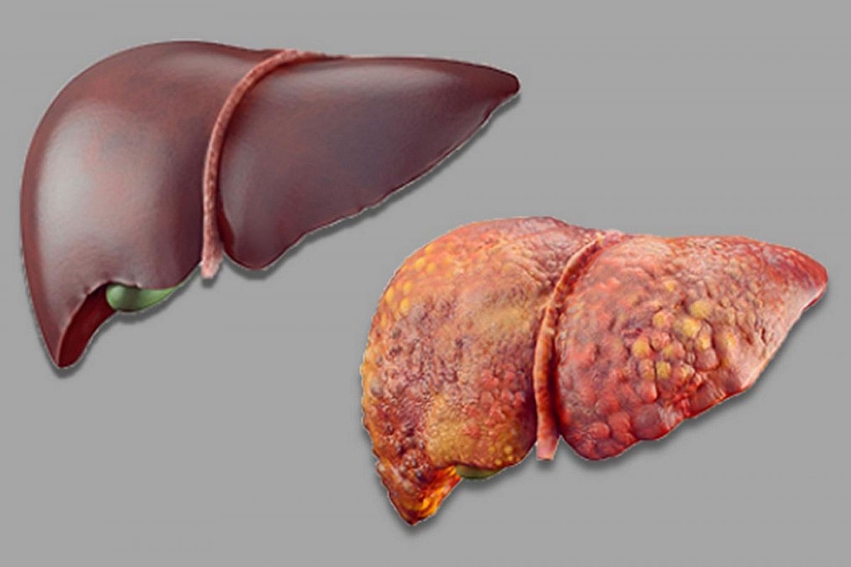 Featured image for Vegetables That May Reverse Liver Disease