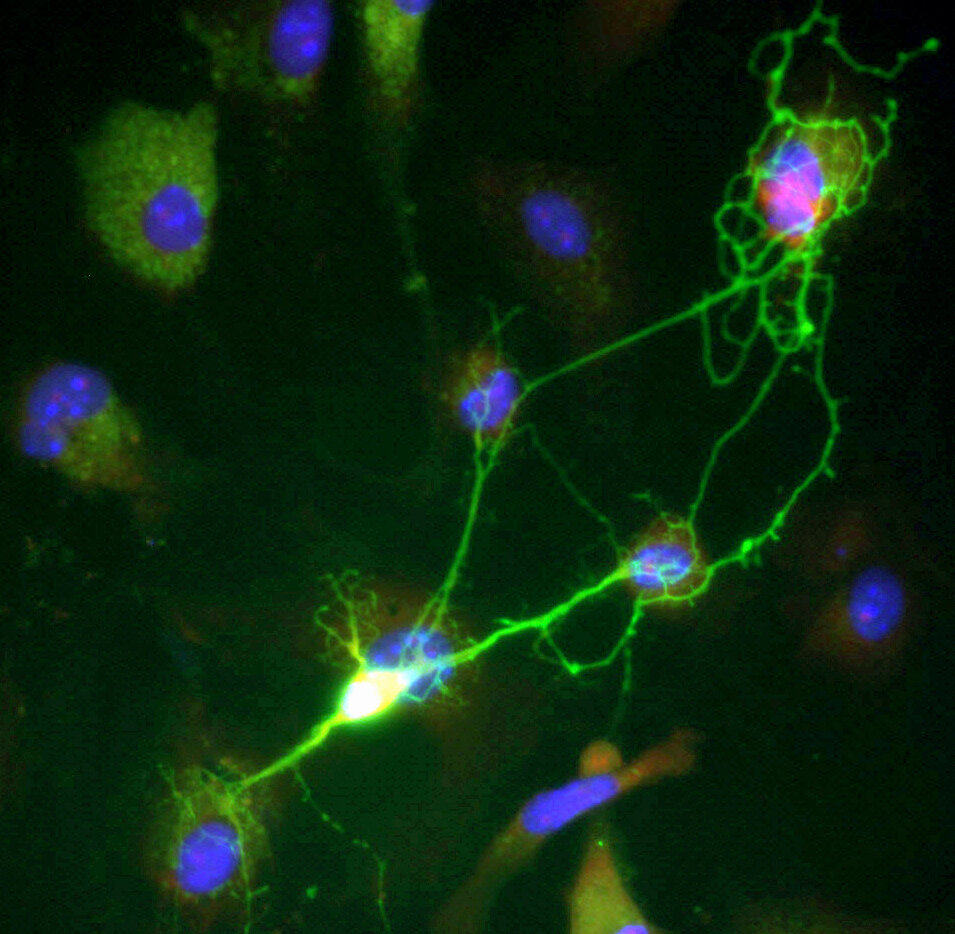 Featured image for Unveiling a Revolutionary Trigger for Parkinson's Disease