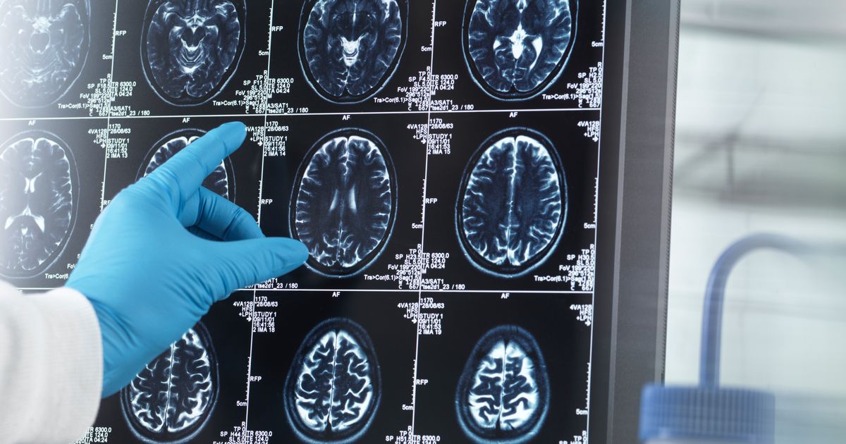 "Powerful Fruit Reduces Dementia Risk, Extending Life by 5 Years"