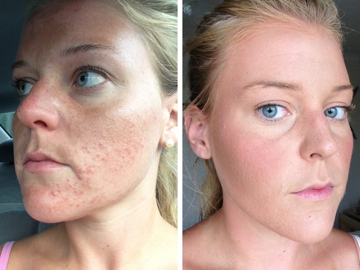 Pregnancy Cured Woman's 18-Year Acne Struggle.