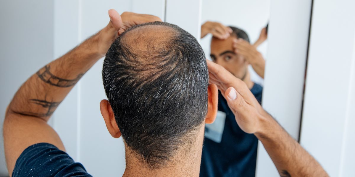 Featured image for Understanding Receding Hairline: Symptoms, Causes, and Effective Treatments