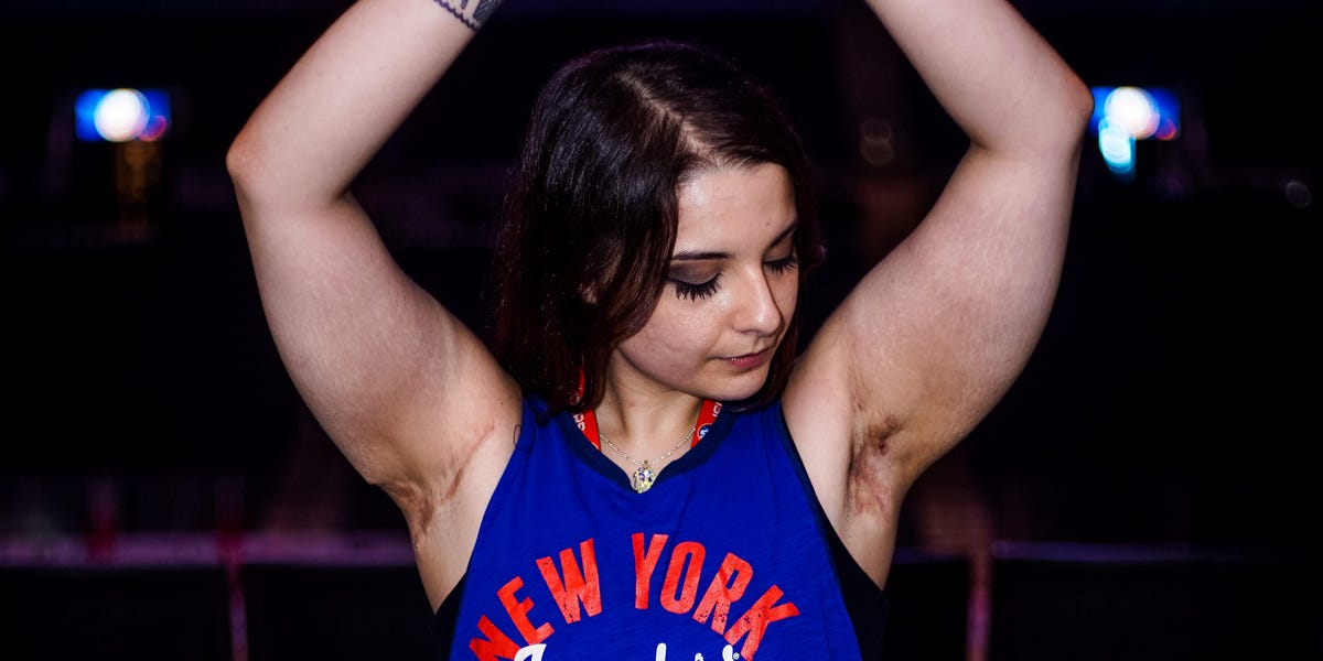 Featured image for Living with Hidradenitis Suppurativa: A Woman's Journey of Discovery