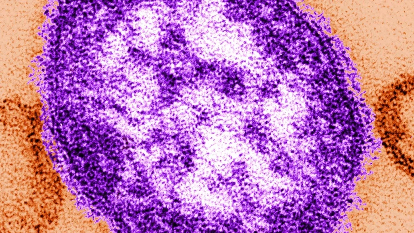 Three local measles cases spark outbreak in Snohomish County
