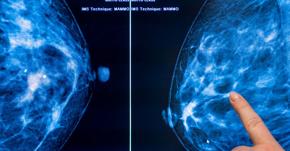 Featured image for Navigating the Changing Landscape of Mammogram Guidelines.