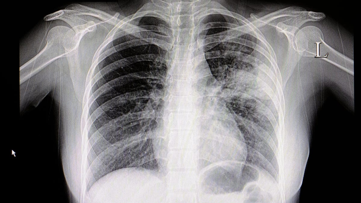 China's Mysterious Spike in Child Pneumonia Cases Raises Concerns