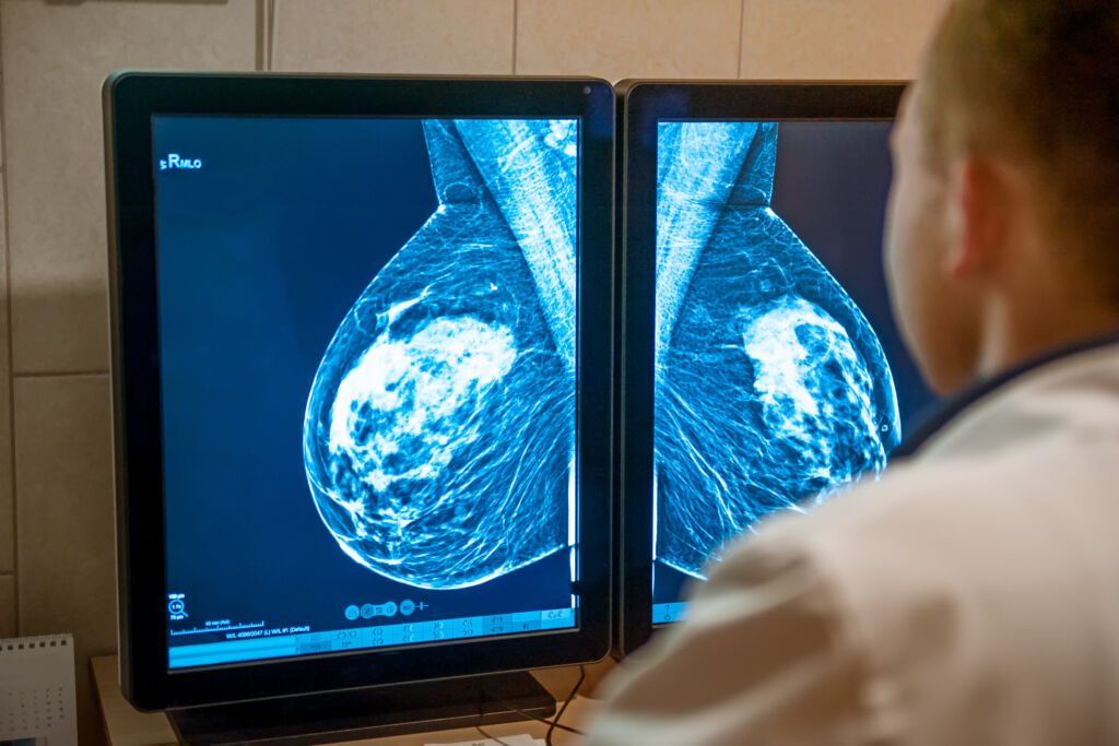 Featured image for "New Federal Guidelines Lower Mammogram Starting Age to Save Lives"