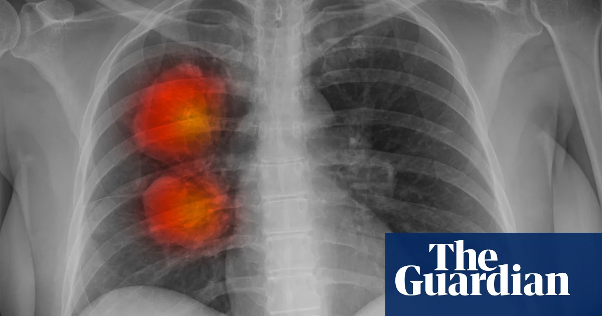 Breakthrough in Cancer Treatment: Targeting DNA Circles for Therapy