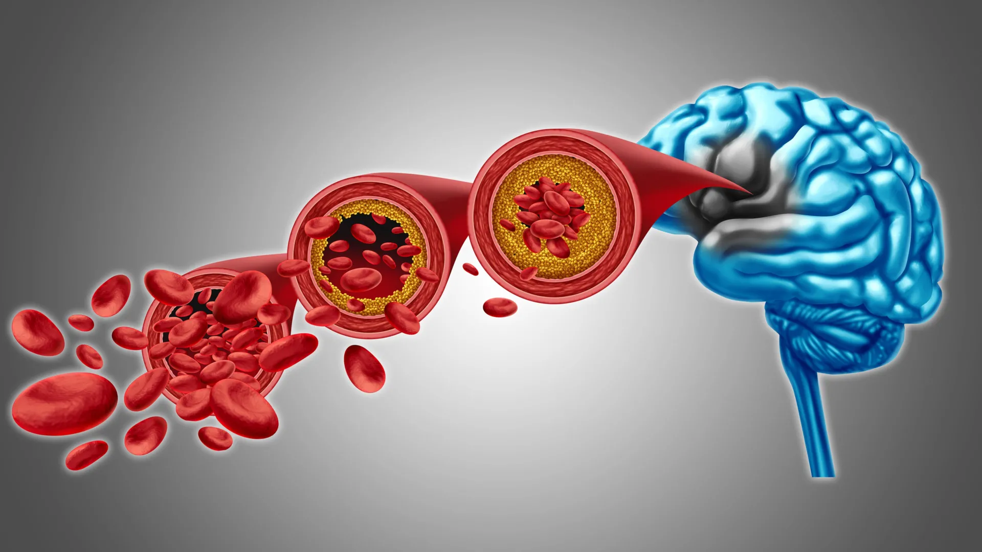Featured image for Restoring Brain Blood Flow and Phospholipids as Potential Treatments for Vascular Dementia