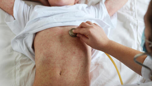 Featured image for "Measles Outbreak in Israel Prompts Urgent Vaccination Appeal"