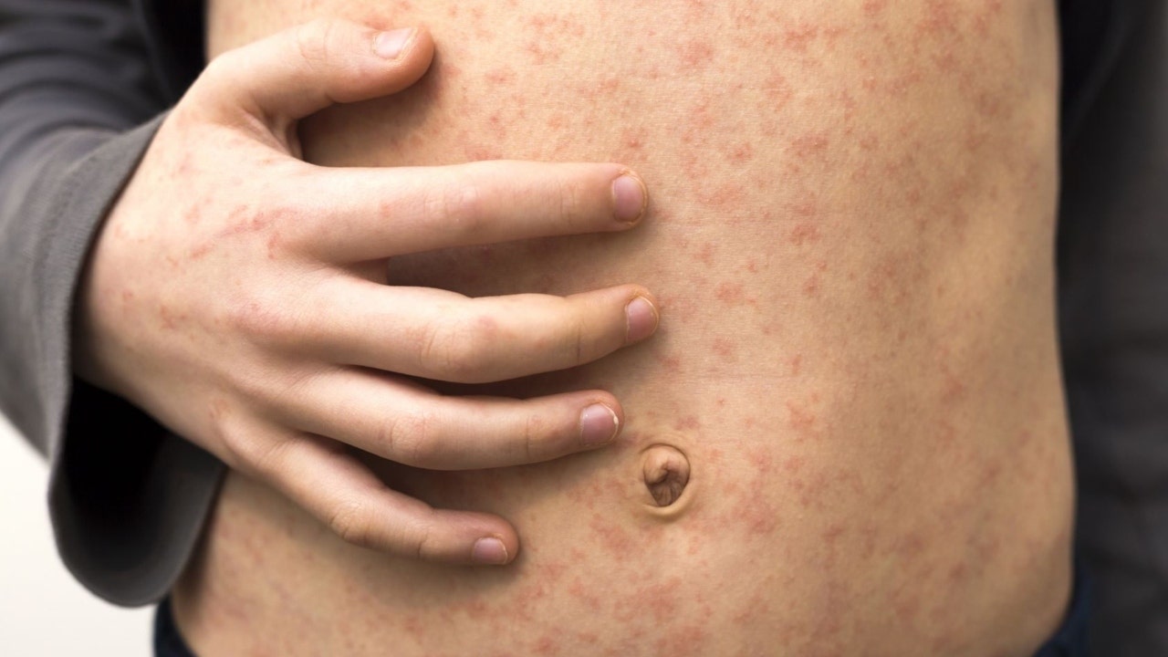 Unvaccinated International Traveler Linked to Third Measles Case in Georgia