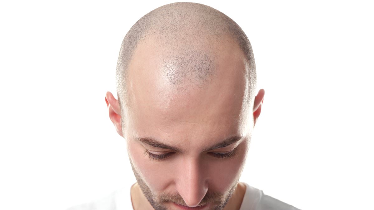 Featured image for "Global Baldness Map: Ranking the Top 20 Countries with the Highest Male Hair Loss Rates"