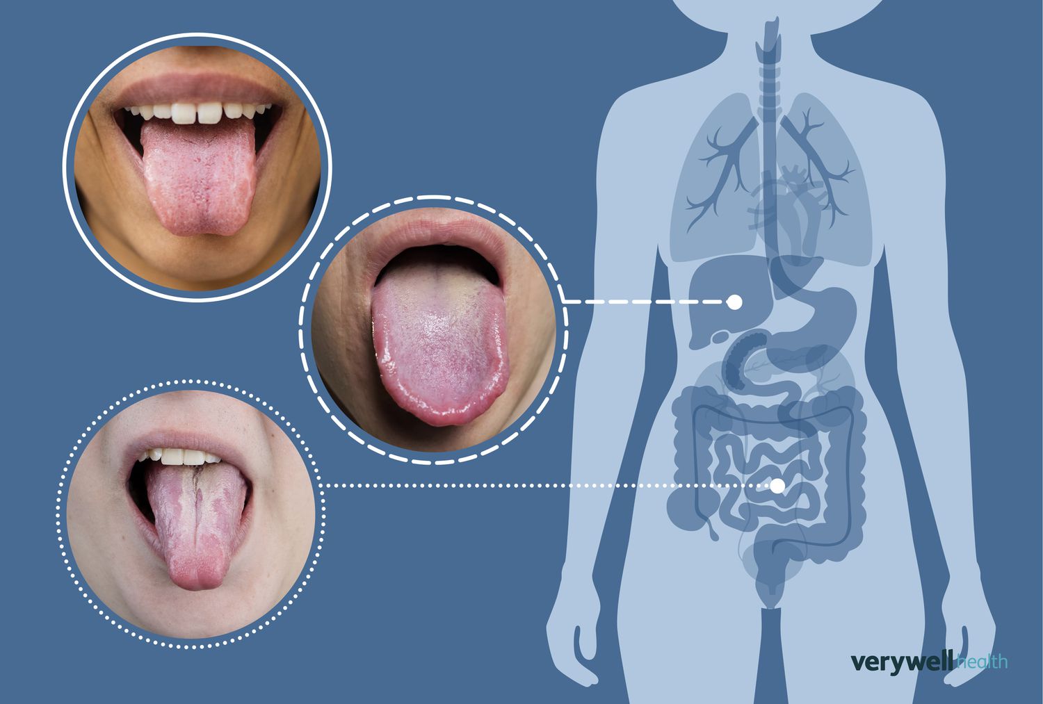 Featured image for Decoding Health through Tongue Color