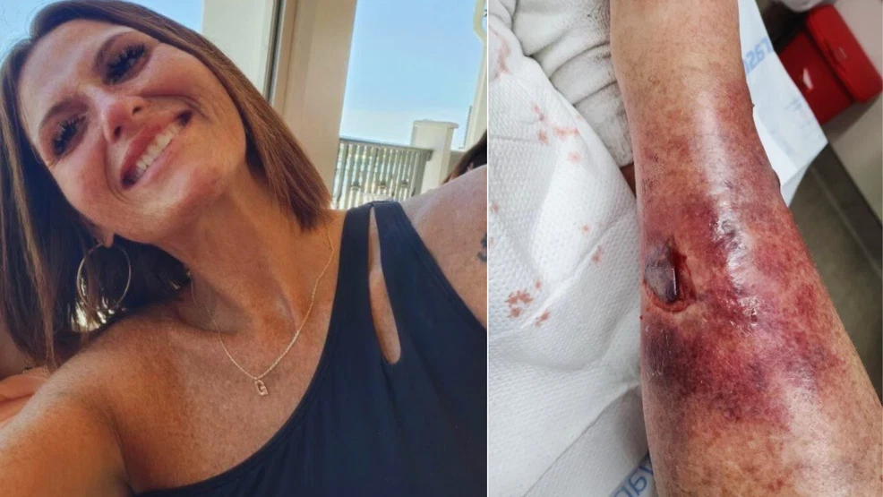 Featured image for Pensacola Mom and Others Fight for Life Amid Rising Vibrio Cases in Florida