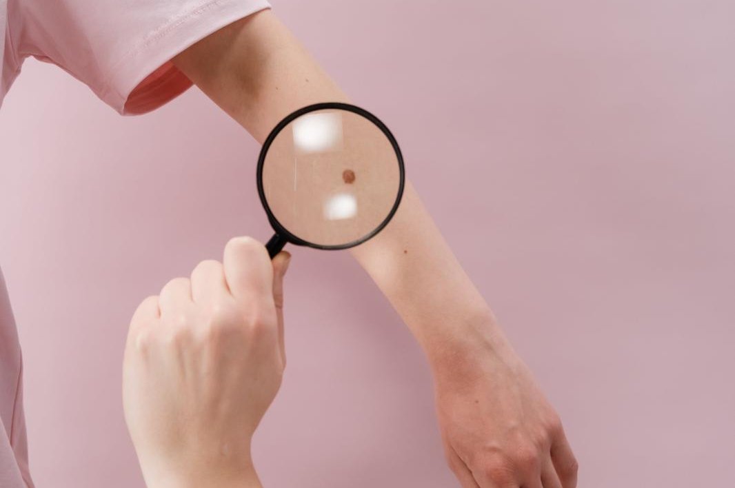 "Promising Results: Melanoma Vaccine Boosts Survival and Reduces Recurrence Risk, Moderna and Merck Lead the Way"