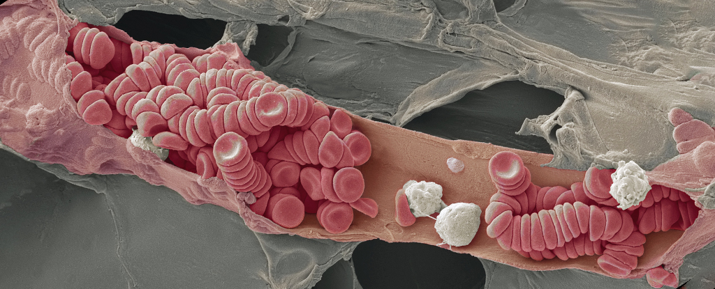 Blood Condition Linked to Alzheimer's Protection: New Biomarker Discovered