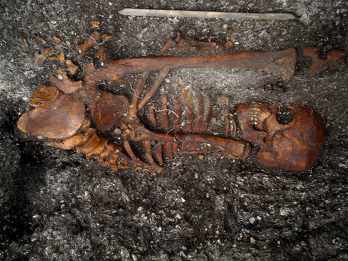 Ancient Syphilis-like Diseases Uncovered in Brazilian Skeletons