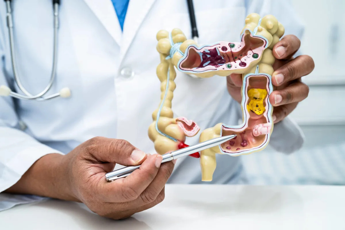 "Discovery of Aggressive Bacteria in Half of Colon Cancer Cases"