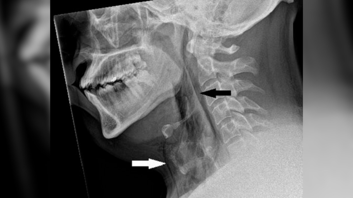 Featured image for Man's Sneezing Mishap Leads to Rare Windpipe Tear