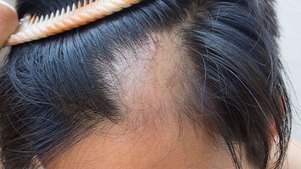 FDA approves hair loss drug for teens and adults with alopecia areata.