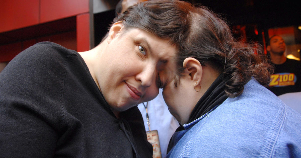 Featured image for "World's Oldest Conjoined Twins, Lori and George Schappell, Pass Away at 62"