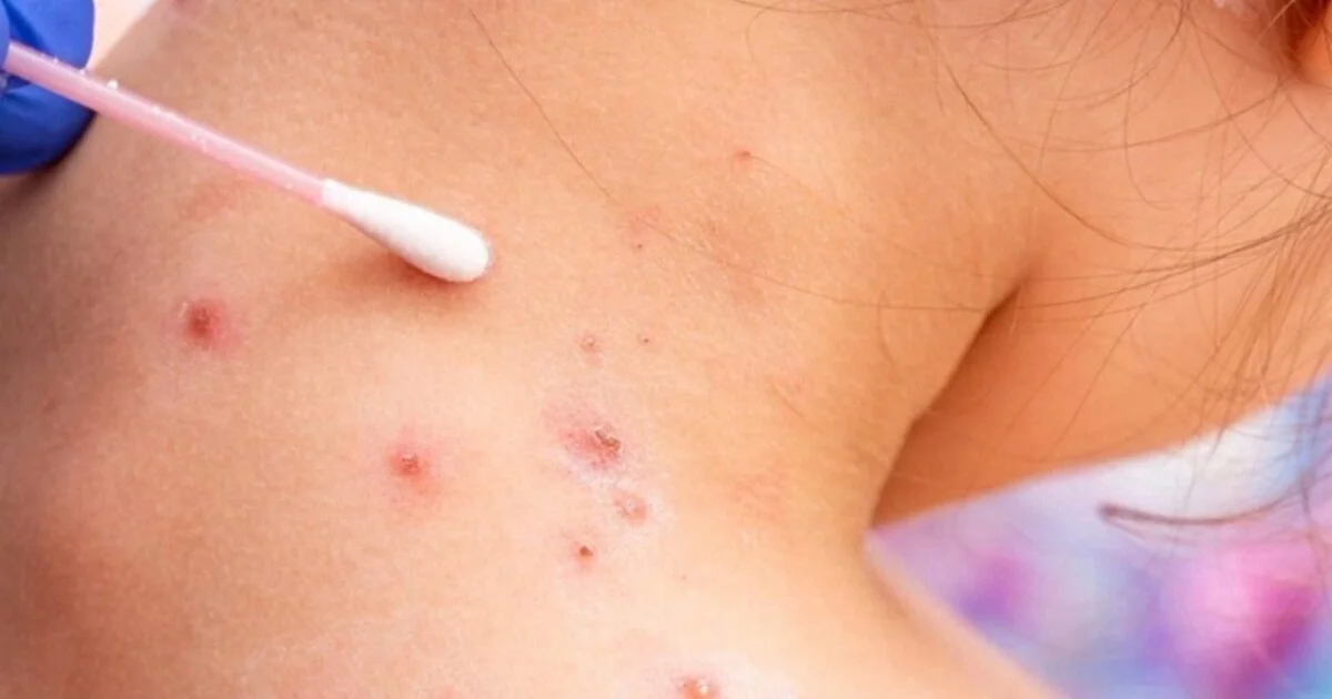 Measles Confirmed in Cascade County