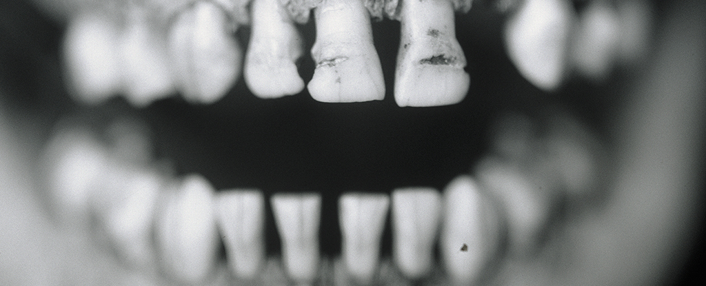 Featured image for Ancient Teeth Reveal Long-lasting Pathogen Signals