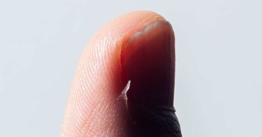 Featured image for "Effective Hangnail Removal Techniques"