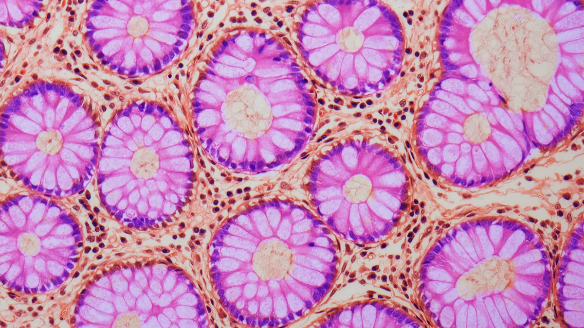 Aging-Driven Epigenetic Drift in Gut Stem Cells May Raise Colorectal Cancer Risk