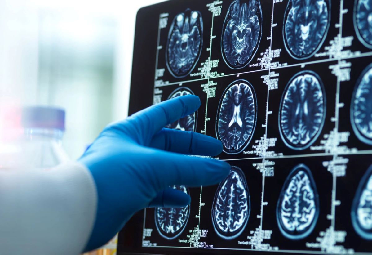 Featured image for COVID-19's Long-Term Brain Effects and Potential Treatments