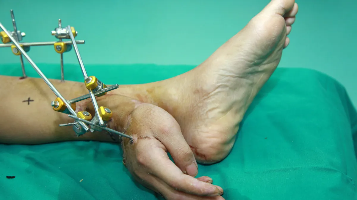 Featured image for Chinese surgeon's remarkable case of reattaching a severed hand to his leg