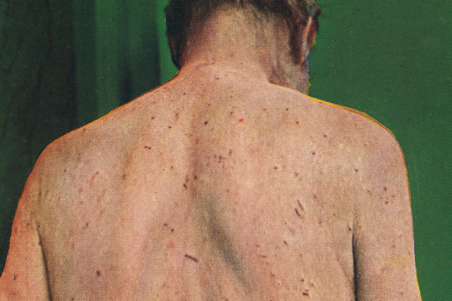 Featured image for "Body Lice Linked to Bubonic Plague Spread"