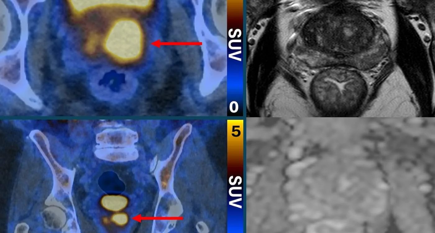 Glow-on Scans Trim Unnecessary Prostate Biopsies