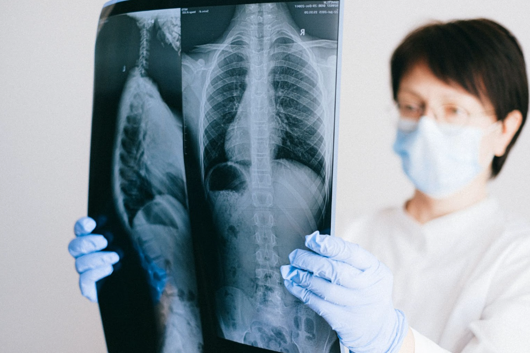 "Exploring the Lucrative Market for Treating Widespread Lung Infections with Over 200,000 Annual Hospitalizations"