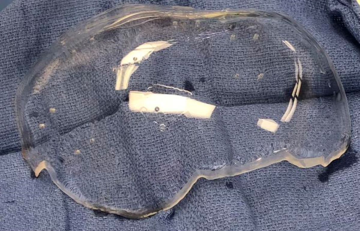 Featured image for "Revolutionary Skull Implant Enhances Brain Imaging"