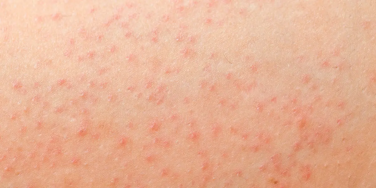 Featured image for "Fungal Acne Prevention: Understanding Folliculitis"