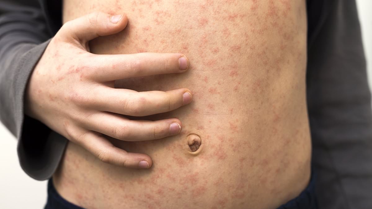 "Florida's Measles Outbreak: Surgeon General Defers to Parents on Unvaccinated Kids in School"