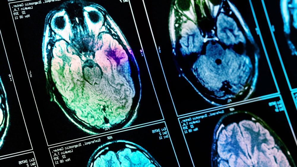 Featured image for Rapport's Seizure Drug Success Sparks Stock Surge