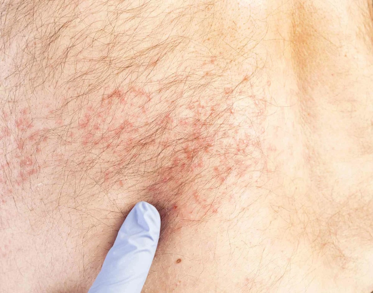 Featured image for Uncovering the Culprits Behind Non-Mosquito Itchy Bumps on Skin.