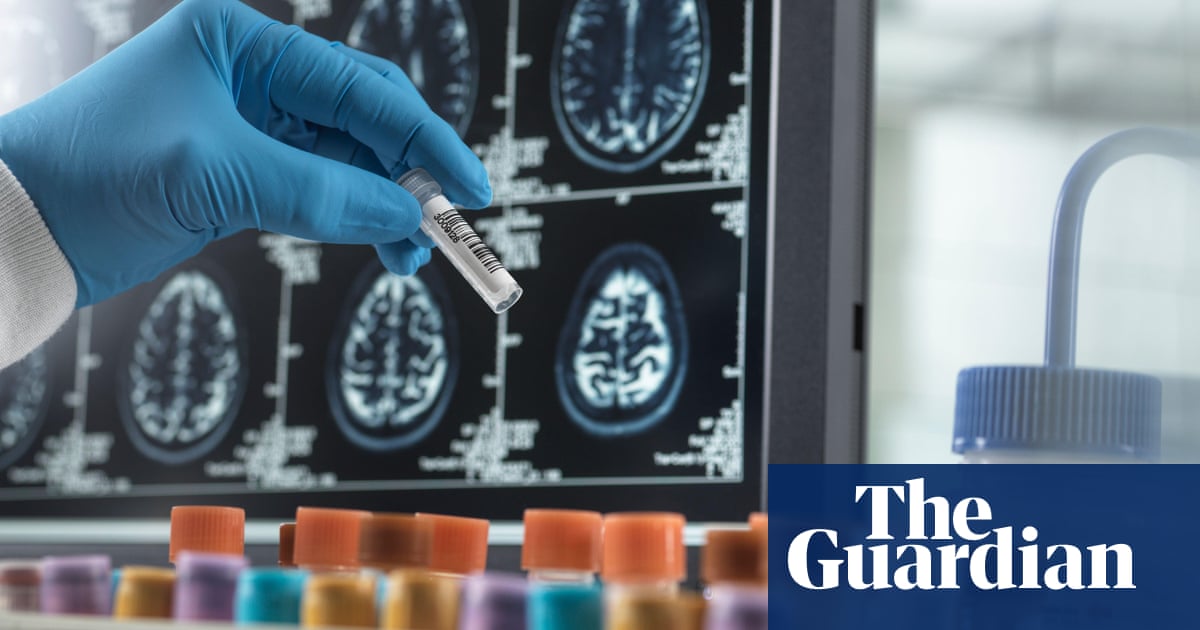 Featured image for "Plasma Protein Test Identifies Early Dementia Risk 15 Years in Advance"