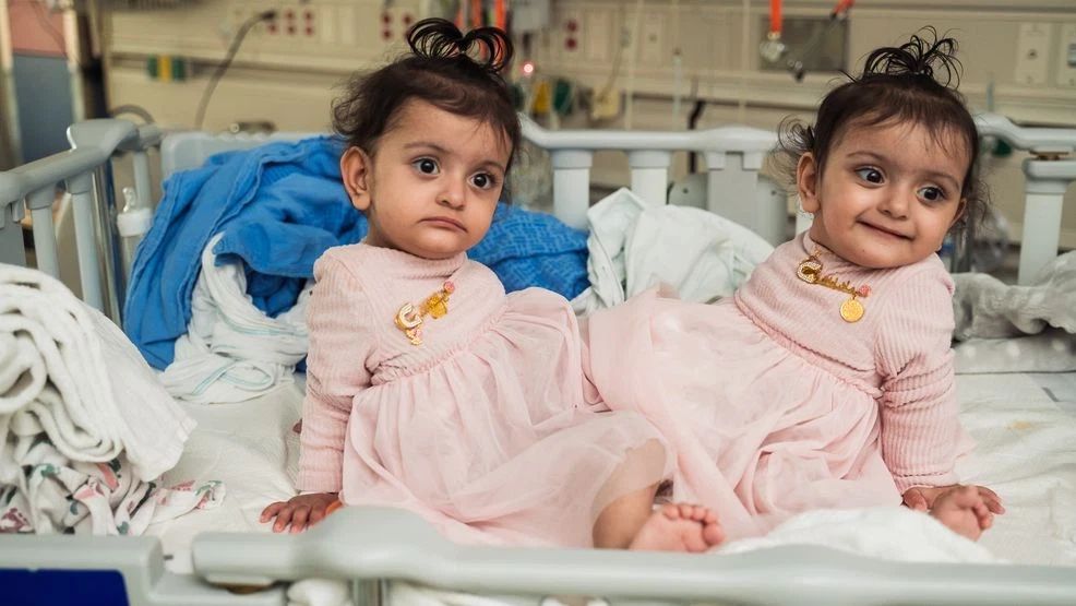 Featured image for Rare Separation Surgery for Conjoined Twins at Seattle Children's