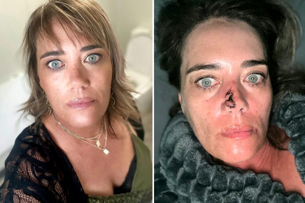 Featured image for Ignoring a Pimple Could Lead to Skin Cancer, Warns Woman Who Discovered Her Birthmark Was Cancerous.